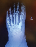 A medical X-ray of a human foot showing surgical screws implanted in the bone near the base of the big toe.